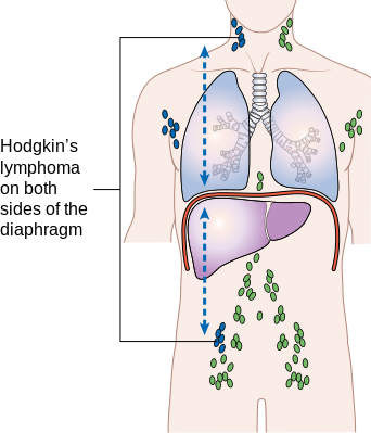 File:Stage 3 Hodgkin's lymphoma.png
