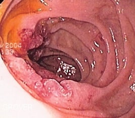 File:Duodenal adenocarcinoma.jpg