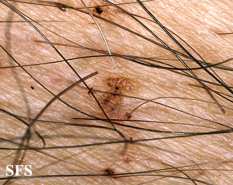 Pediculosis pubis. Permission from Dermatology Atlas.[11]