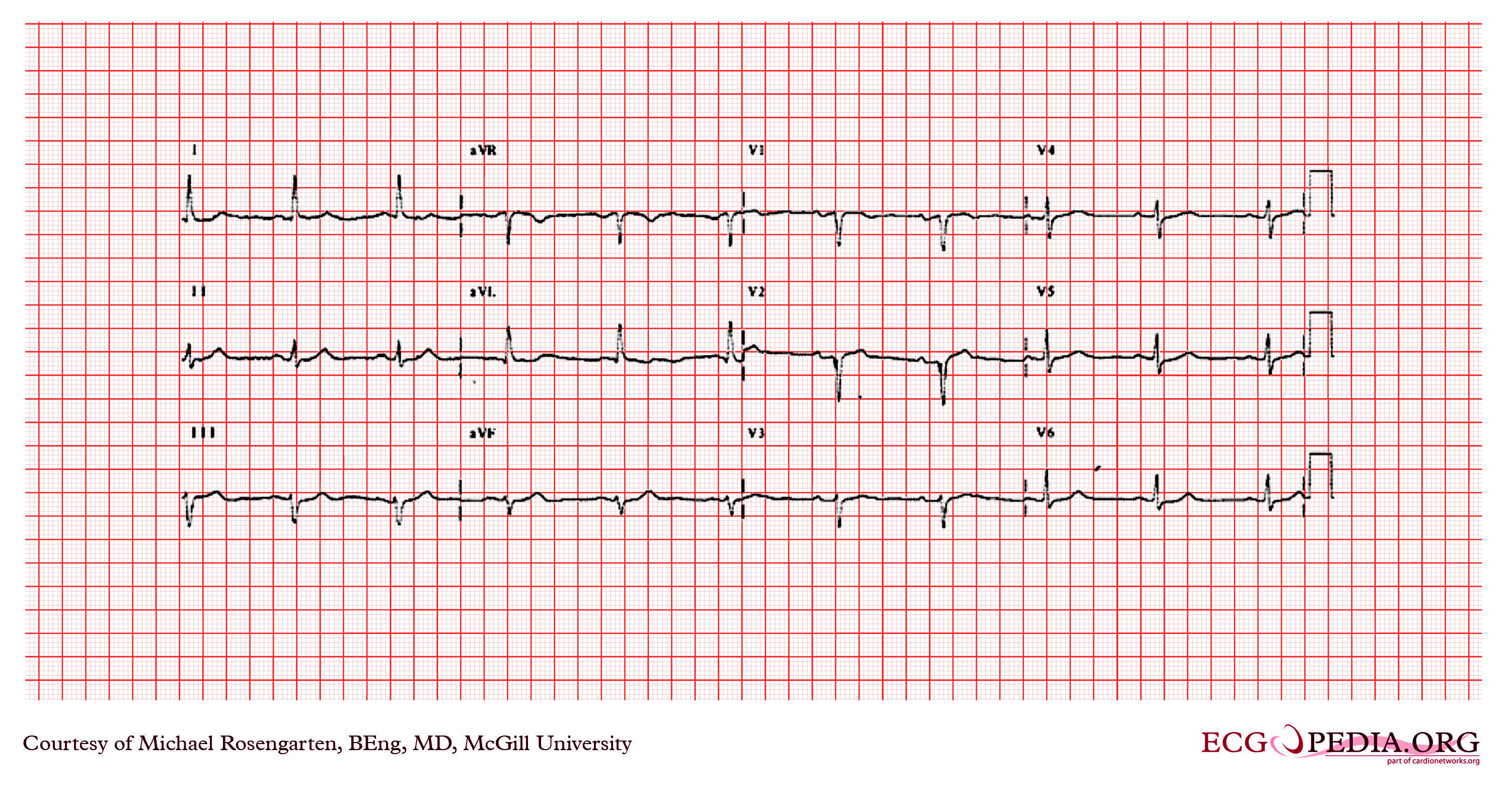 File:Previous anterior wall myocardial infartion..jpg