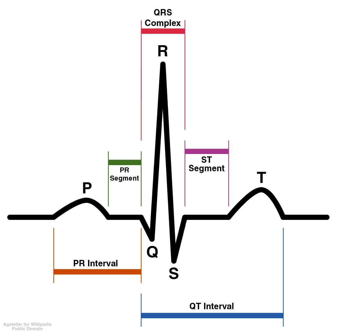 The P waves, which represent depolarization of the atria, are irregular or absent during atrial fibrillation.