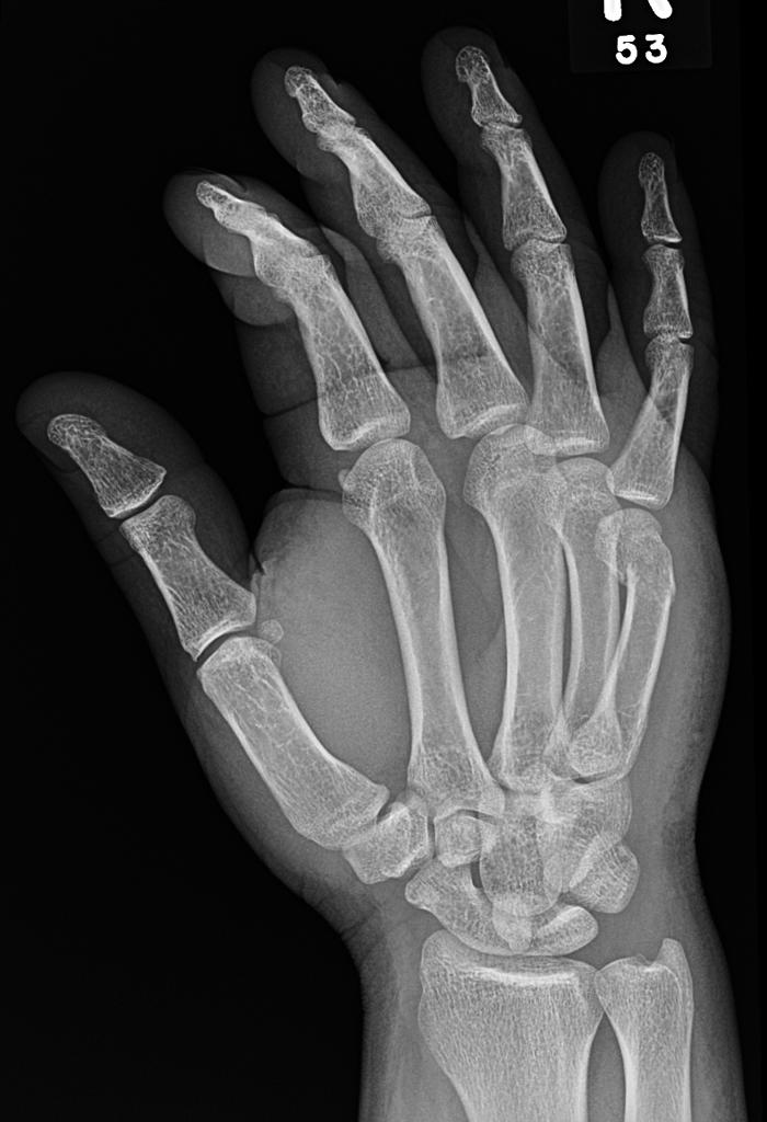 File:Boxer-fracture-12 (1).jpg