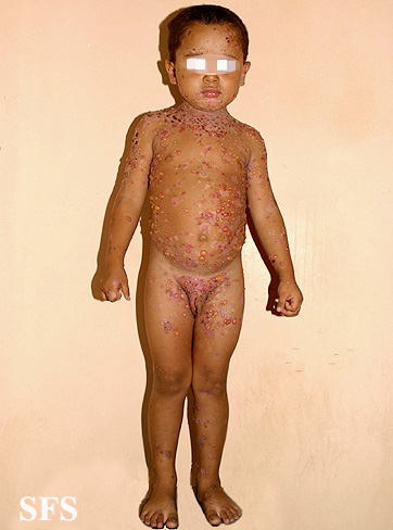 File:Childhood linear IgA disease01.jpg