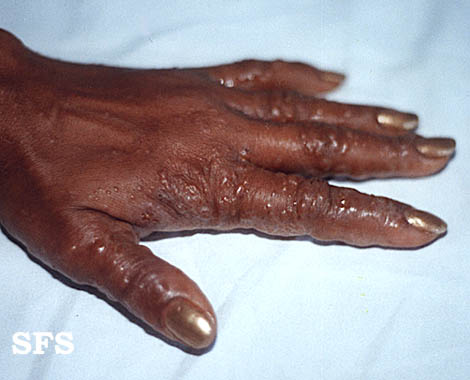 File:Dyshidrotic eczema01.jpg