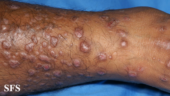 File:Epidermolysis bullosa pruriginosa32.jpg