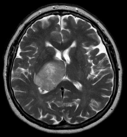 File:Glioblastoma multiforme - MRi.jpg