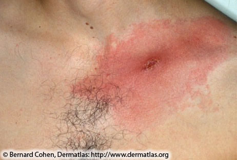 File:Lyme disease Expanding rash with central crust.jpg
