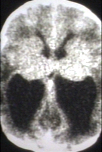 Brain: Arnold Chiari II, Hydrocephalus (CT)