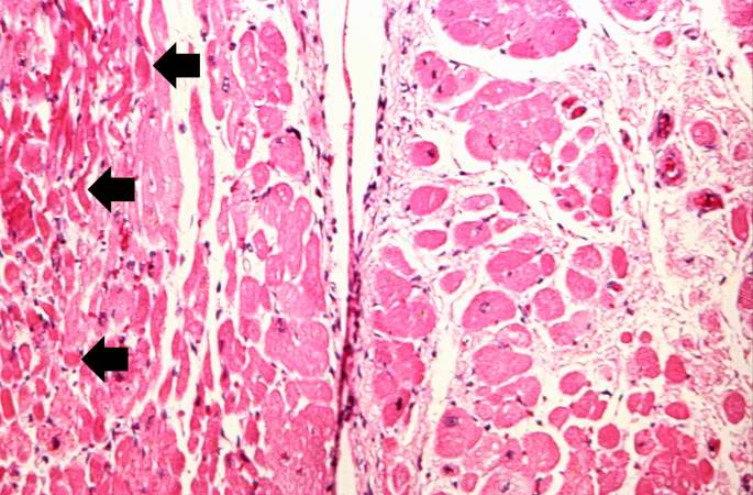 This is a high-power photomicrograph of another area of this section. There are several hypereosinophilic cells within this section (arrows).