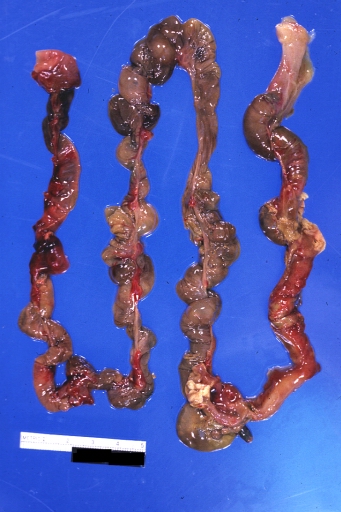 Small intestine: Necrotizing Enterocolitis: Gross, natural color, four loops of bowel with obvious dusky cyanosis (very good example}