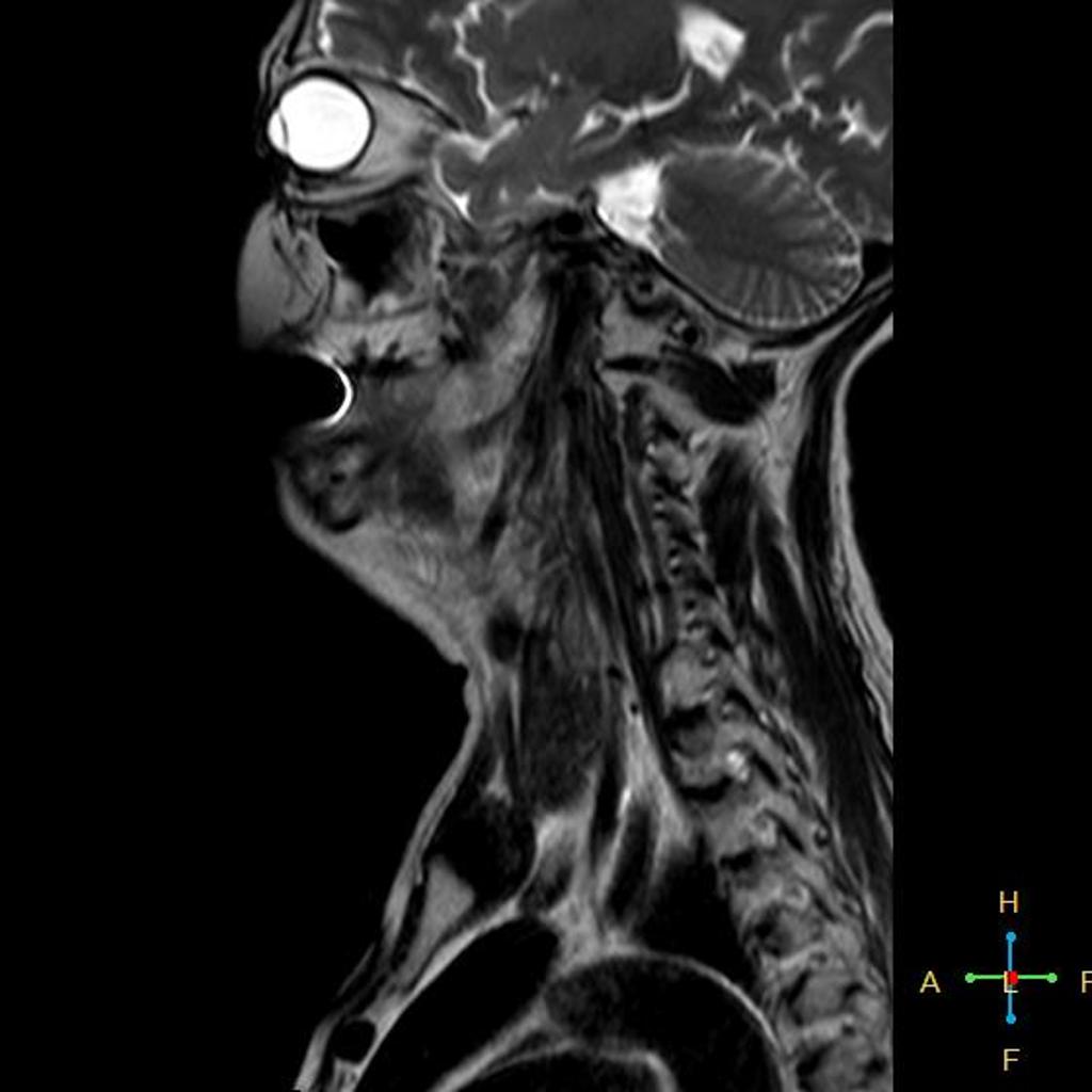 Post cricoid carcinoma MRI [3]