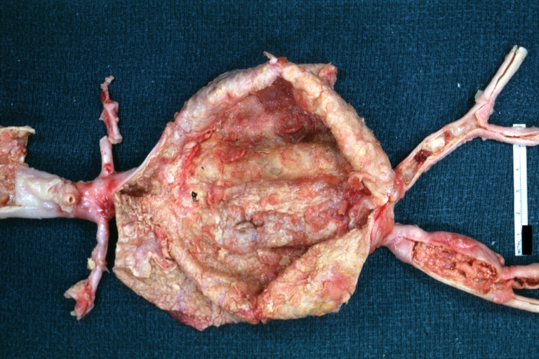 Abdominal Aneurysm: Gross, natural color, large aneurysm opened showing sessile calcified plaques with no mural thrombus. Lesion extends from renal arteries to the bifurcation (the same lesion seen externally with focus of rupture)