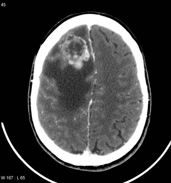 Ct scan with contrast of the patient with known metastatic breast cancer, complaining of headache, demonstrates a solitary heterogenously enhancing right frontal lobe mass with extensive surrounding edema. The mass has it's epicenter close to the grey white matter junction.[5]