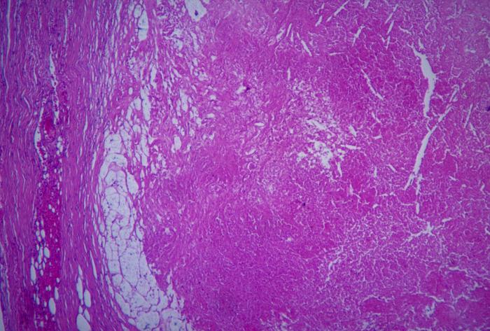 Micrograph depicts the histopathologic changes associated with cryptococcosis of an adrenal gland. From Public Health Image Library (PHIL). [7]