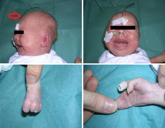 File:Phenotypic features of Timothy syndrome.gif