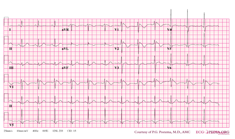 File:Brugada syndrome type1 example4.png