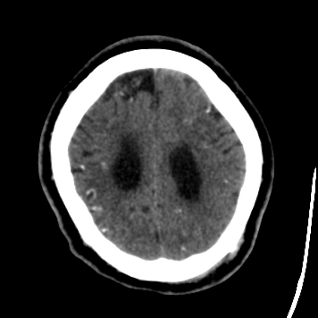 CT shows multiple intraparenchymal calcifications with enlarged ventricles and increased extracranial soft tissue in the left parieto-occipital region