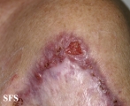 Lupus Vulgaris. Adapted from Dermatology Atlas.[15]