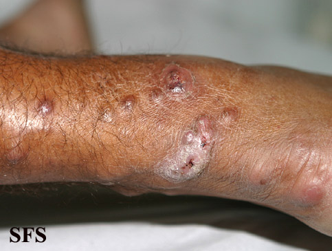 Lepromatous leprosy. Adapted from Dermatology Atlas.[5]