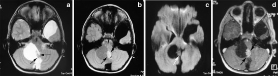 A large, cystic cerebellar pilocytic astrocytoma in a 7-year-old boy. a An axial T2-weighted image shows a hyperintense mass of the right cerebellar hemisphere with a less intense soft-tissue nodule along its medial margin and without surrounding oedema (arrows). Note the arachnoid cyst in the left middle cranial fossa. b On an axial FLAIR image, the cystic component shows low signal intensity that is higher than that of the CSF, and the soft tissue nodule is homogeneous and slightly hyperintense (arrows). c On a diffusion-weighted image, the mural nodule appears isointense (arrow). d An axial, contrast-enhanced, T1-weighted image demonstrates intense enhancement of the mural nodule (arrows).[2]