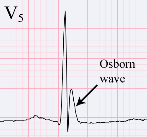 Osborn-wave1.gif