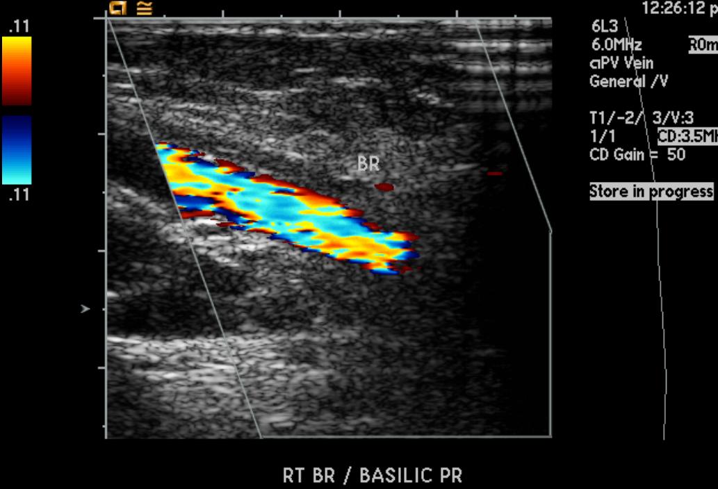Thromboembolism ultrasound - wikidoc