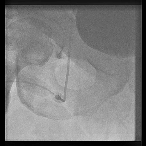 Higher Level puncture of femoral artery and cannula kinking. Copyleft image courtesy of C. Michael Gibson.