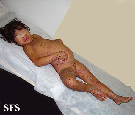 File:Childhood linear IgA disease16.jpg