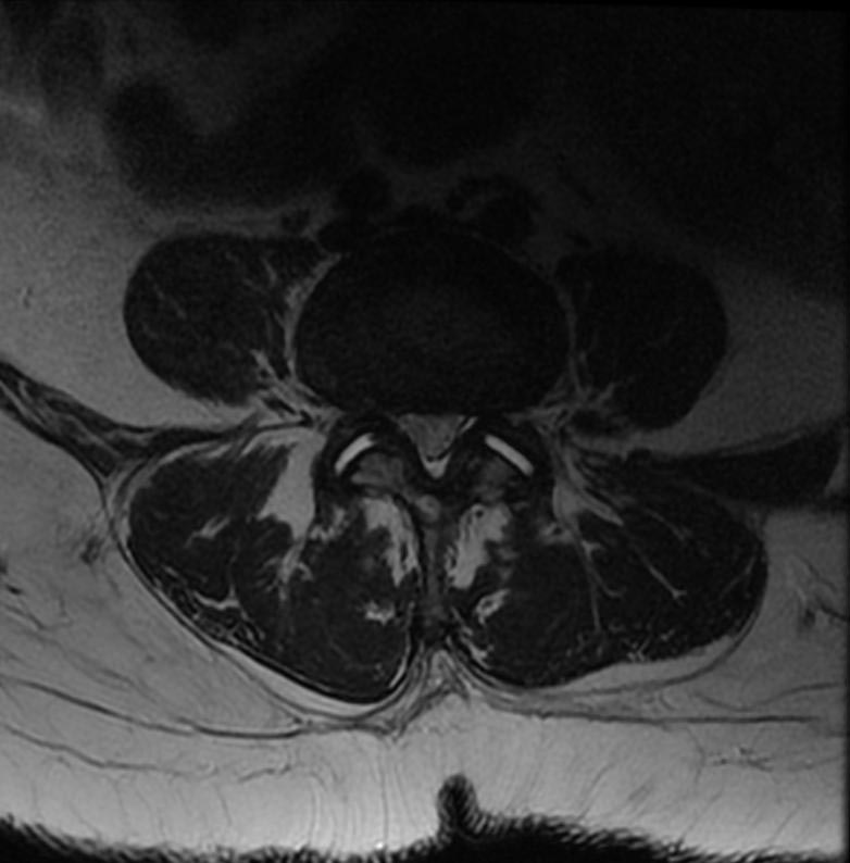 File:Intraspinal synovial cyst 003.jpg