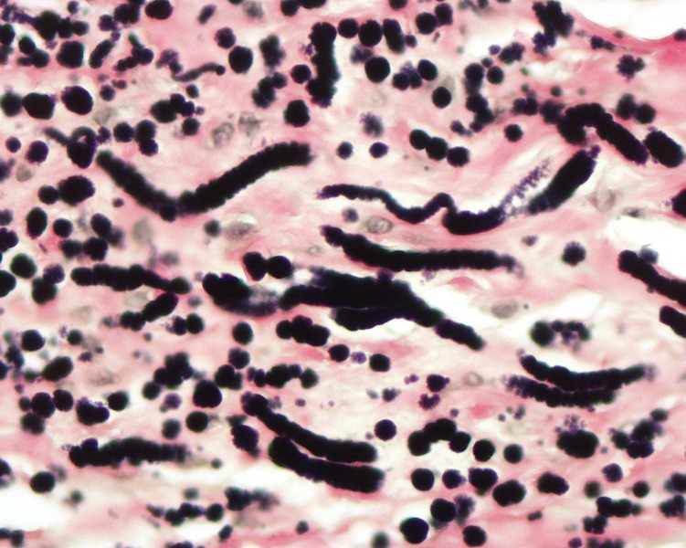 File:Lossy-page1-751px-Elastofibroma stained with elastic stain LDRT tif.jpg