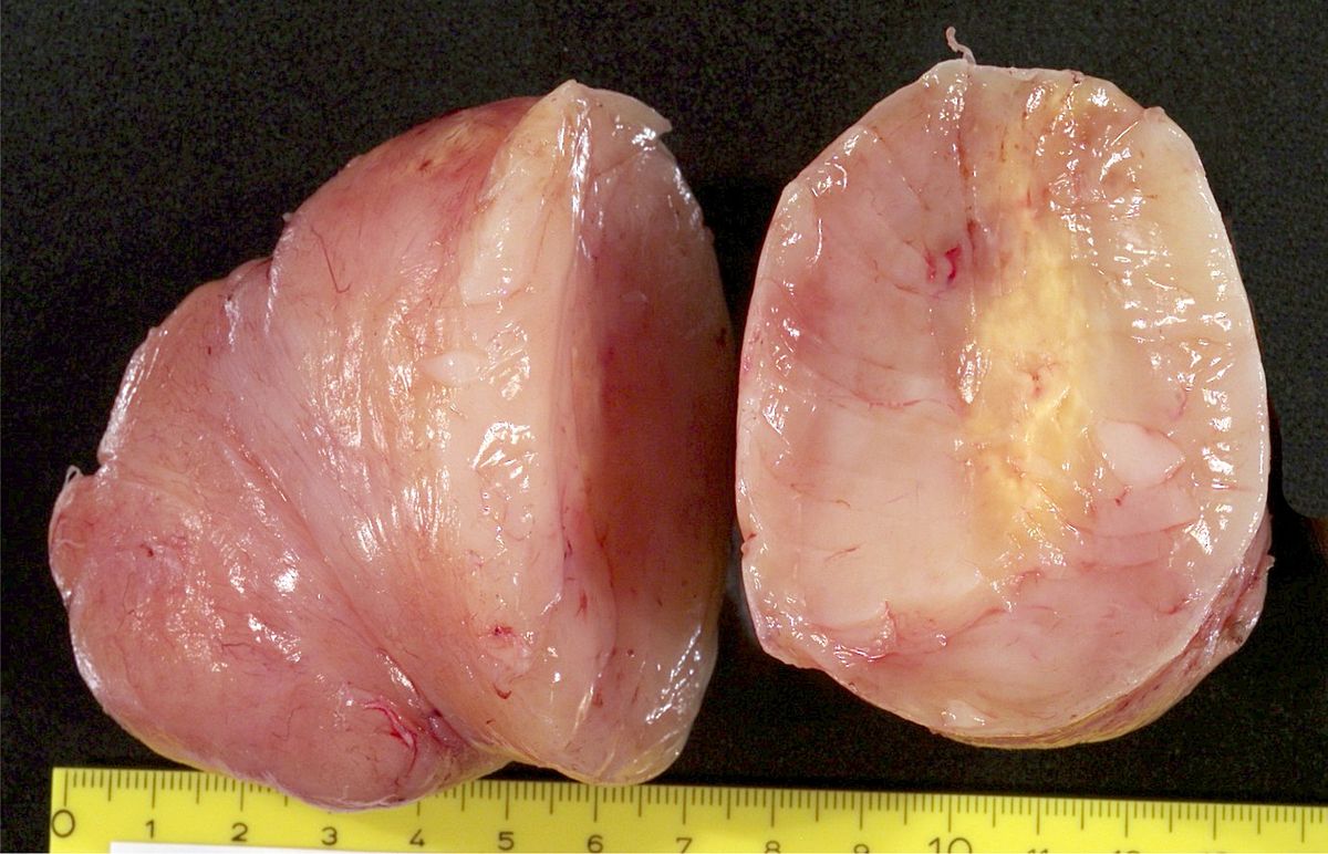 Macroscopical specimen of a Neurofibroma in a Neurofibromatosis type I patient. Such lesions can attain a considerable size.[11]