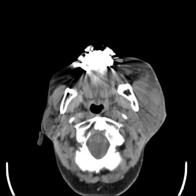 The left parotid gland is diffusely and moderately enlarged with adjacent fat stranding extending to buccal space.From Radiopaedia Image Library. [3]