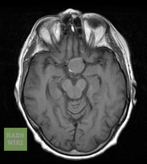 There is a well defined round lesion noted in the pituitary fossa, the lesion is homogeneous and isodense on T1.[7]