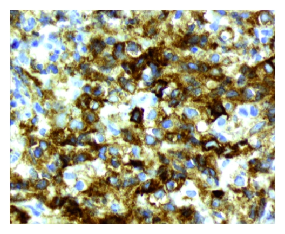 Primary mediastinal large B-cell lymphoma immunoreactivity for CD30[3]