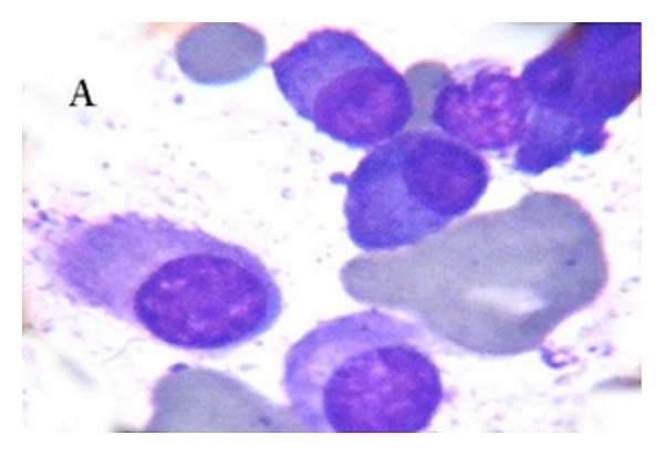 Plasmacytoid cells in the bone marrow aspirates