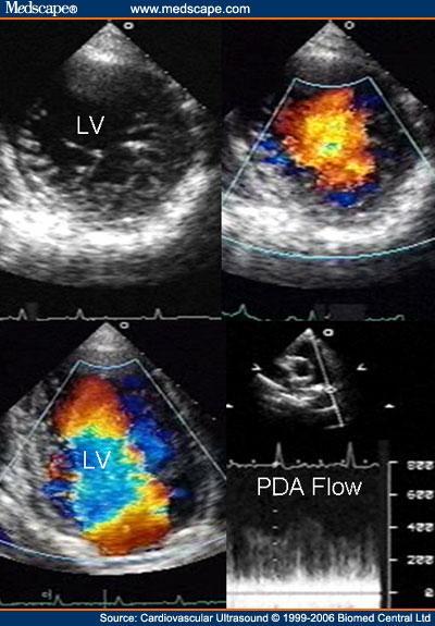 Transthoracic two-dimensional study with color and continuous wave Doppler shows left ventricular noncompaction associated with patent ductus arteriosus (PDA). [2]
