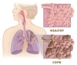 File:Copd versus healthy lung.jpg