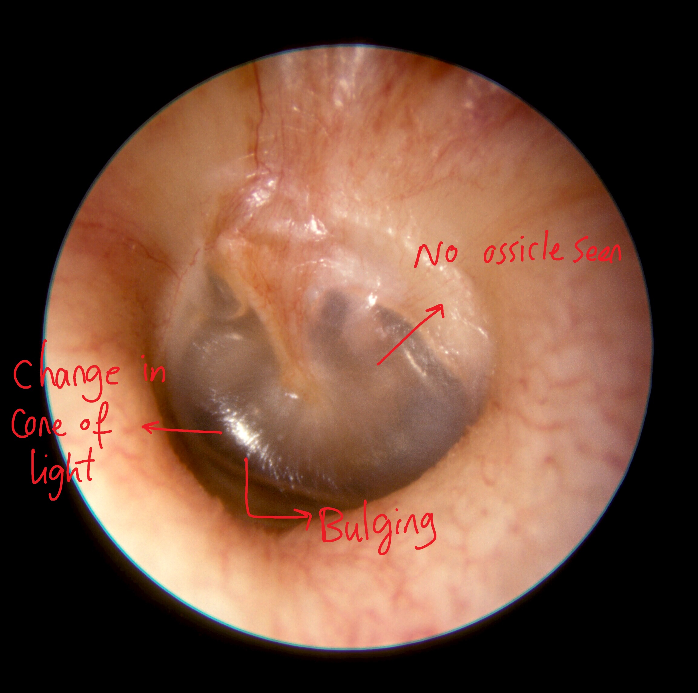 Middle ear effusion