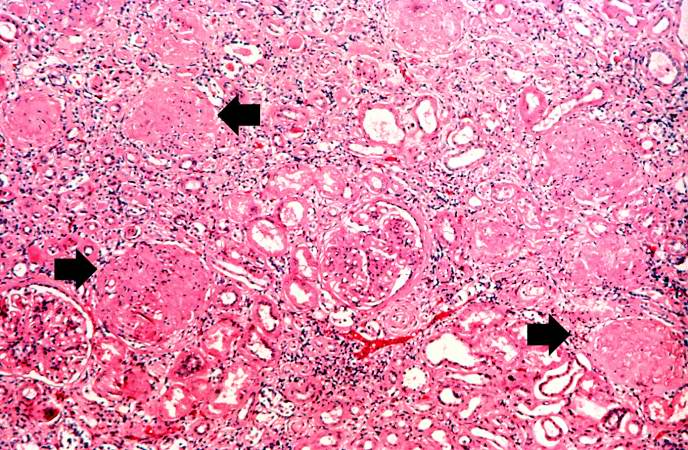 This is a higher-power photomicrograph of hyalinized glomeruli (arrows) and glomeruli with thick basement membranes.