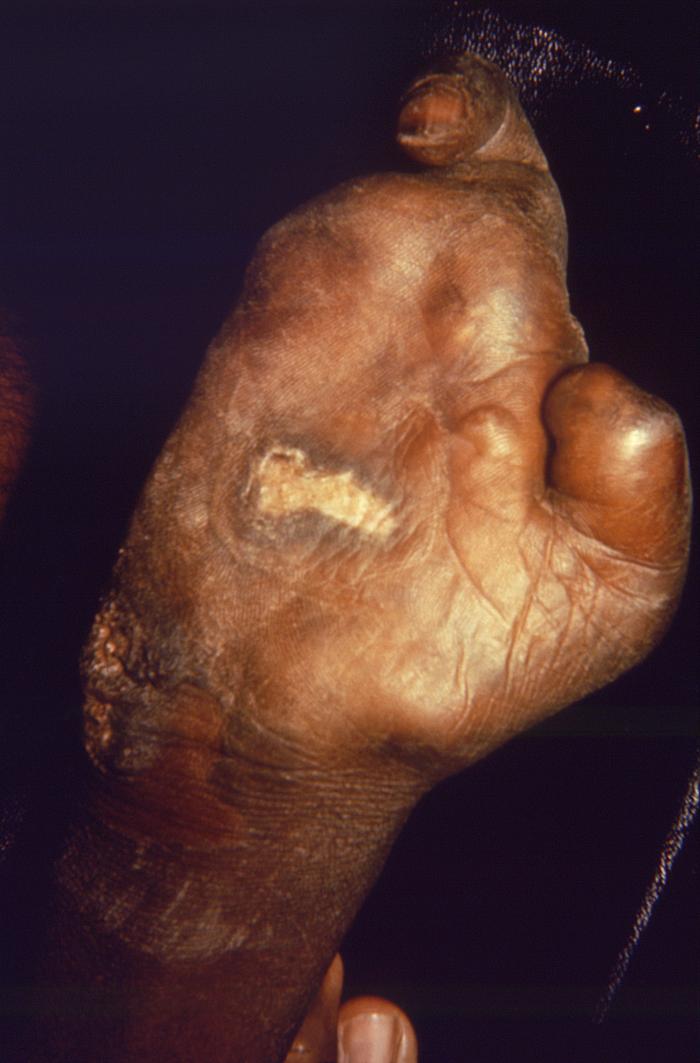Lepromatous or multibacillary leprosy. Late stage with digits almost fully resorbed, except for the index finger, and the proximal remnant of the thumb. Note granulomatous inflammatory lesion on palmar surface. Adapted from Public Health Image Library (PHIL), Centers for Disease Control and Prevention.[6]