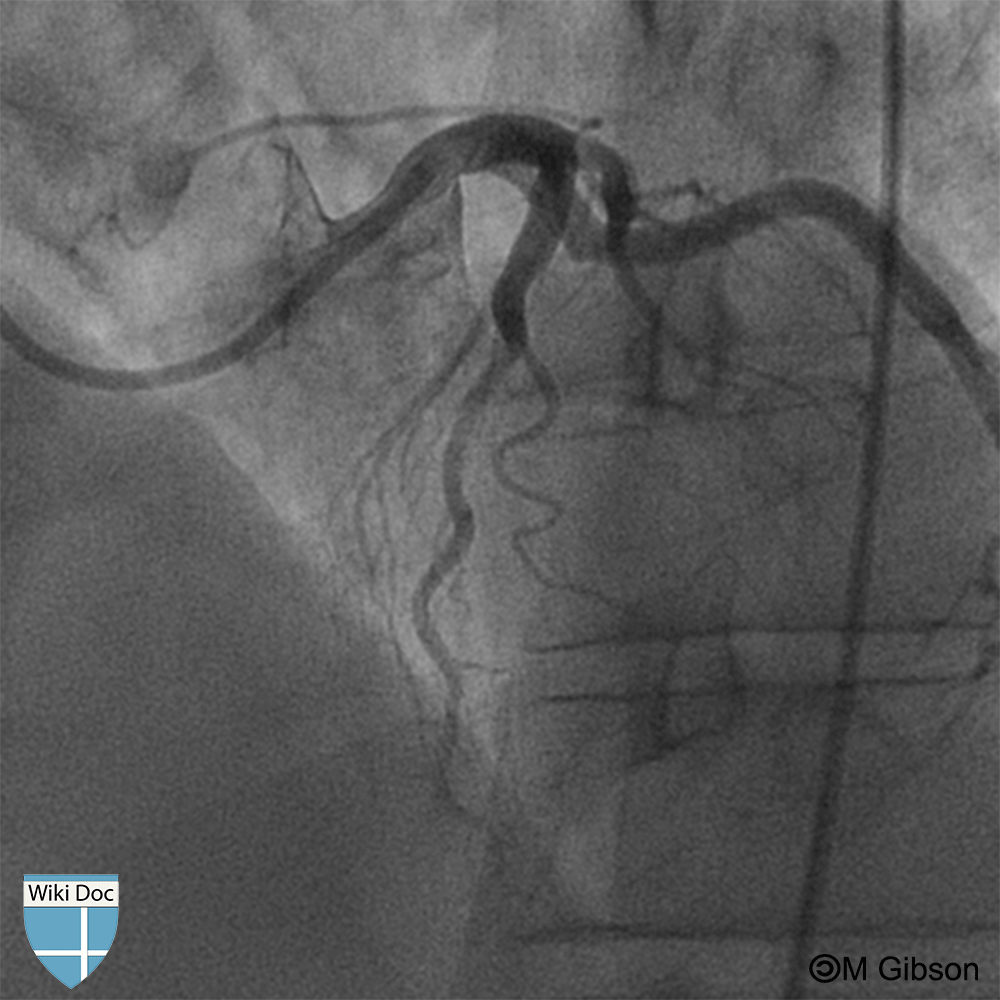The coronary artery is narrowed during systole which is consistent myocardial bridging.