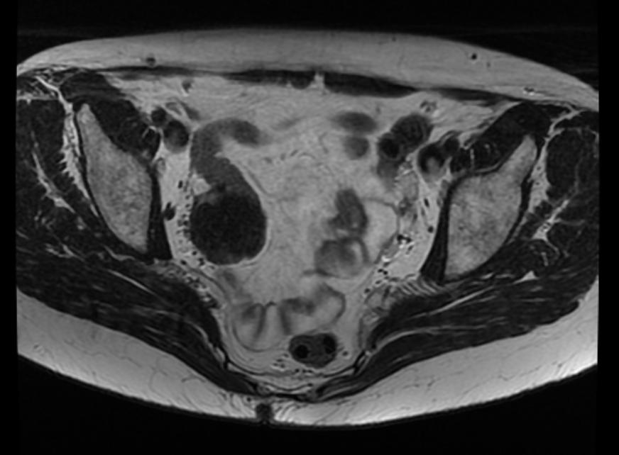 MRI: Ovarian fibroma.