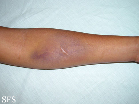 Painful bruising syndrome. With permission from Dermatology Atlas.[5]