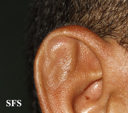 Pseudocyst of ear. Adapted from Dermatology Atlas.[6]