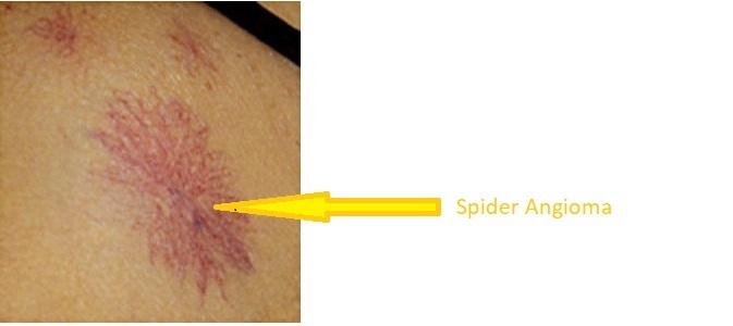 File:Spider angioma p.jpg