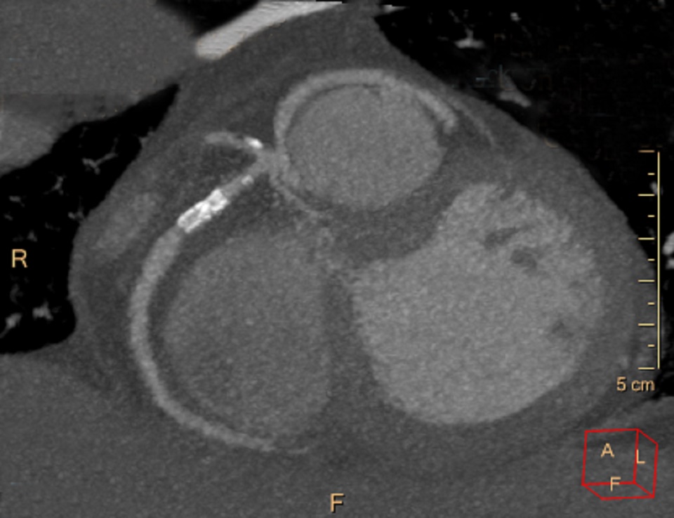 Figure 8. Maximum intensity slab computed tomography image demonstrating the origins of the right coronary artery, left anterior descending artery, acute marginal and circumflex artery, all from a single trunk emerging from the right sinus of Valsalva. RCA (right coronary artery); LCx (left circumflex coronary artery); LAD (left anterior descending coronary artery); RVOT (right ventricular outflow tract)