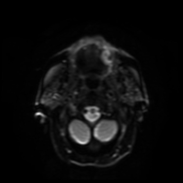 MRI of squamous cell carcinoma of tongue with Axial diffusion weighted imaging [2]
