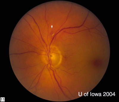 Central Retinal Artery Occlusion (embolus; painless, unilateral vision loss)[1]