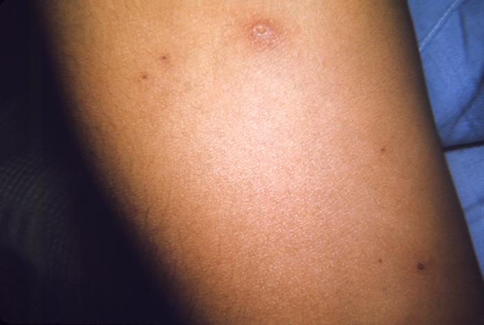 Case of chickenpox. From Public Health Image Library (PHIL). [1]