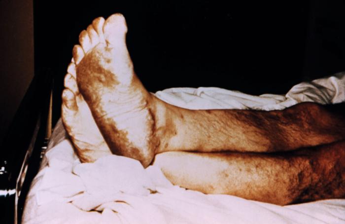 Plantar foot rash was suspected to be smallpox related, but was later determined to be caused by herpes zoster virus. From Public Health Image Library (PHIL). [8]